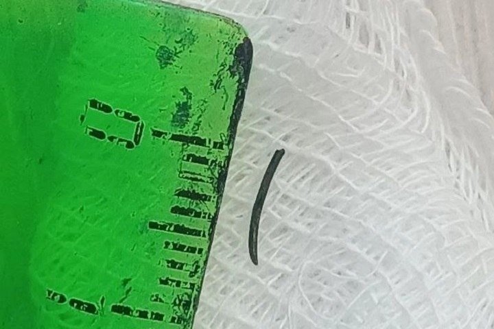 Житель Приморья едва не ослеп из-за отлетевшей щетинки шлифовальной щетки Краевая клиническая больница №2